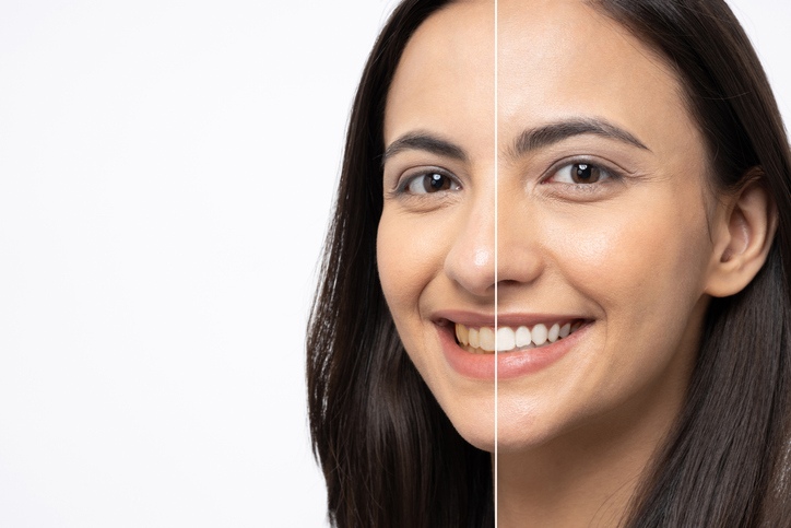 Before & after comparison of a woman showing teeth whitening results in South Bend, IN