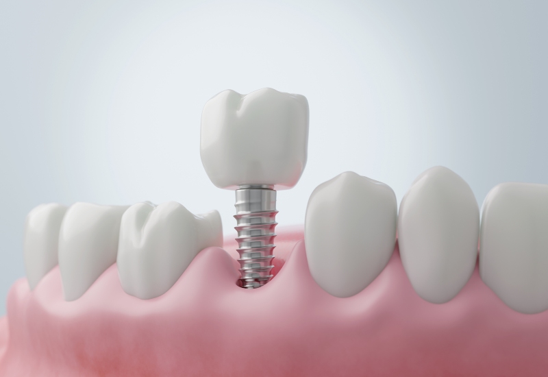 A 3D model of a dental implant with a crown, showcasing restorative dentistry in South Bend, IN