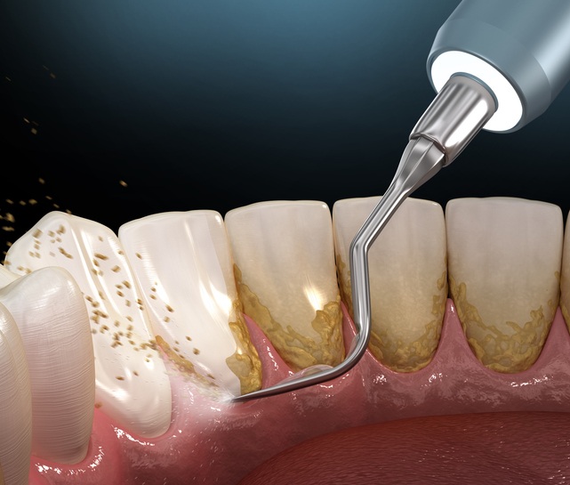 Dental cleaning tool removing plaque and tartar from teeth in South Bend, IN
