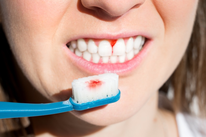 Person brushing teeth with visible gum bleeding and blood spots in South Bend, IN